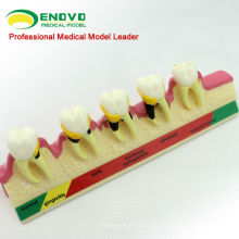 TOOTH09 (12585) Modelos de enfermedad periodontal crónica